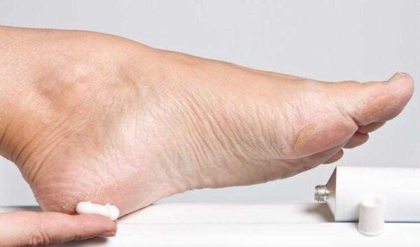 Creme Caseiro para Rachadura nos Pés Simples de Fazer